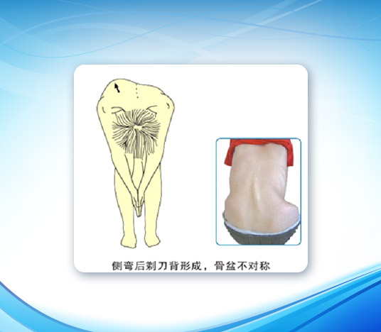 脊柱側(cè)彎矯形器-2(圖1)